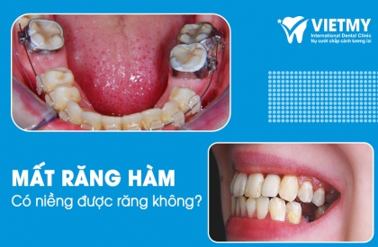 Niềng Răng Cho Người Mất Răng Hàm: Lựa Chọn Thông Minh Hay Không?